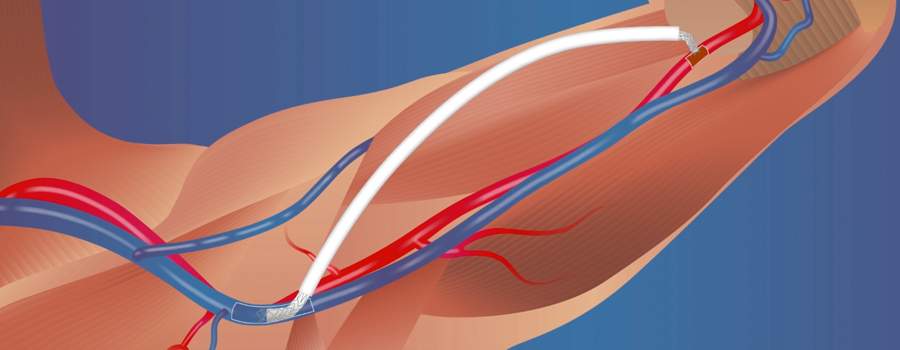 Illustration of an implanted Phraxis InterGraft arteriovenus graft